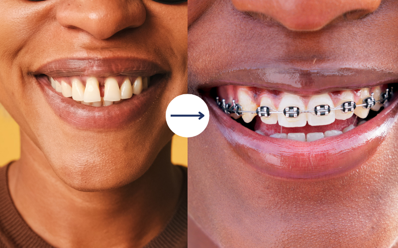 dental implant at My Tooth Studio, Thane