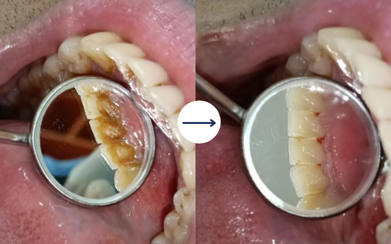 dental retainers – My Tooth Studio Thane