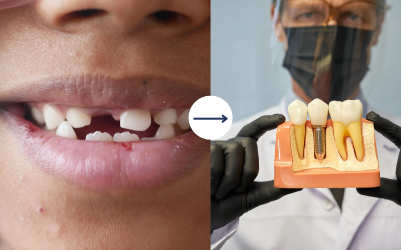 dental implants in Thane at My Tooth Studio, Thane